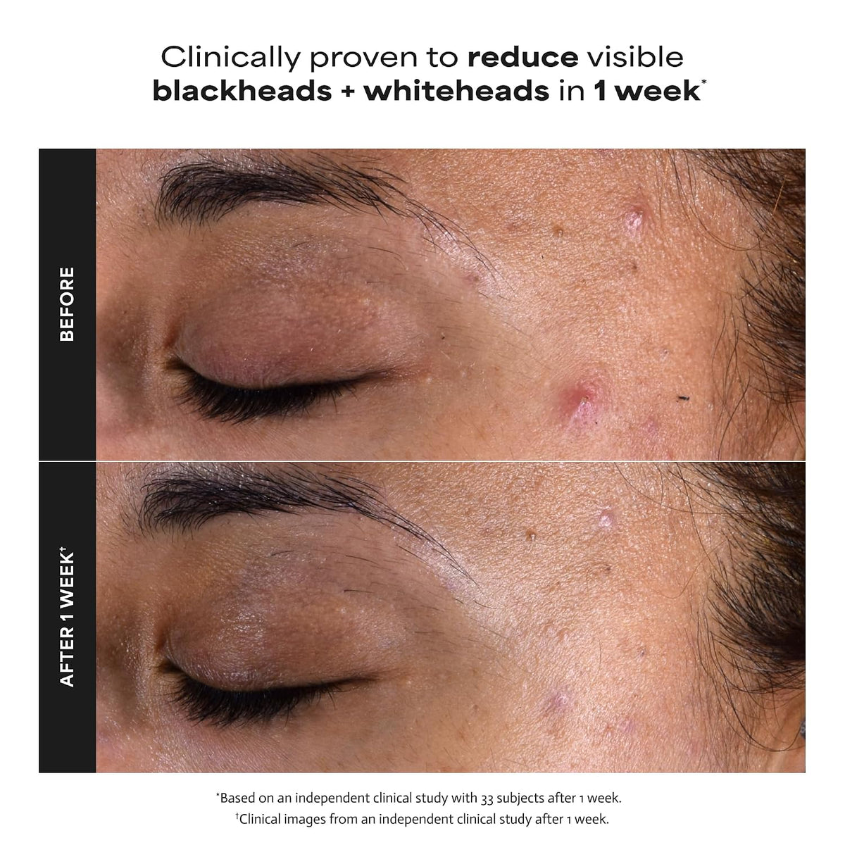 Paula's Choice Skin Perfecting 2% BHA Liquid Exfoliant